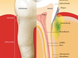 Parodontitis / Parodontose Behandlung in Fürth durch Zahnarzt Aalai
